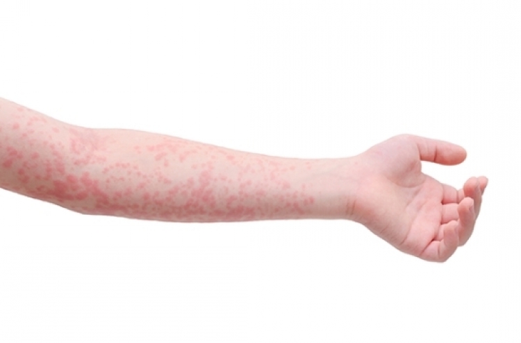 Scarlet fever increases hundredfold in 6 years