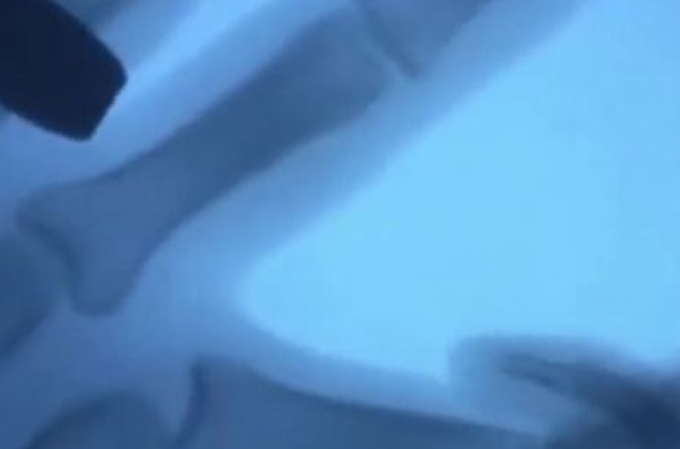 손가락 마디꺾기 MRI 동영상...관절염 검사 ‘의외’
