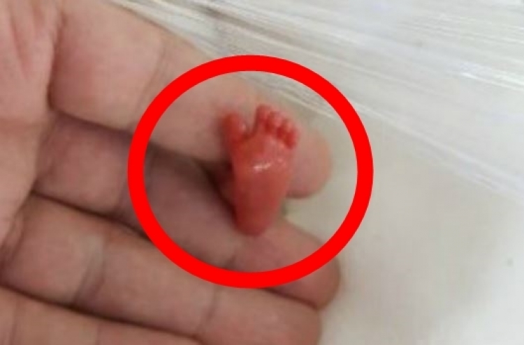 세상에서 가장 작은 아기 탄생… 0.4kg
