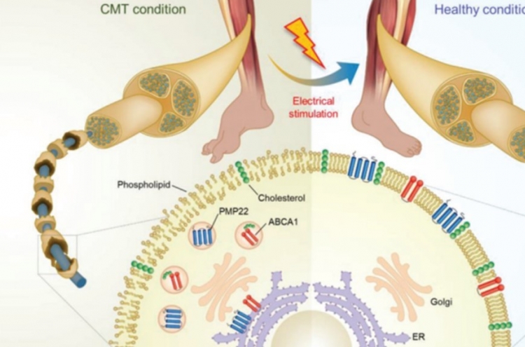 Scientists develop world's 1st therapy for Charcot-Marie-Tooth disease
