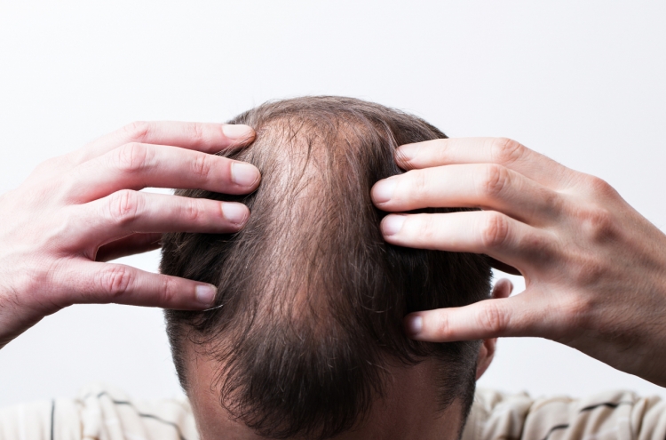 Municipalities offer subsidies for hair loss treatment