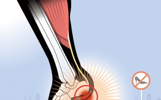 Plantar fasciitis