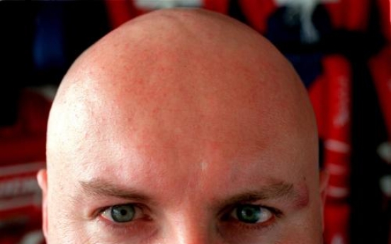 Baldness protein found in study that may lead to treatments