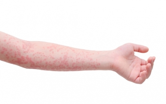 Scarlet fever increases hundredfold in 6 years
