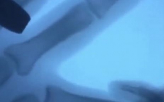 손가락 마디꺾기 MRI 동영상...관절염 검사 ‘의외’