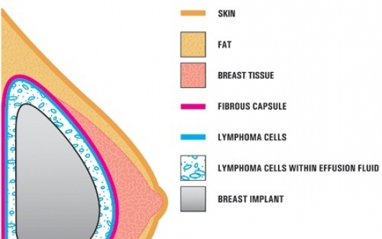 Are ‘water drop’ breast implants a ticking time bomb in the chest?