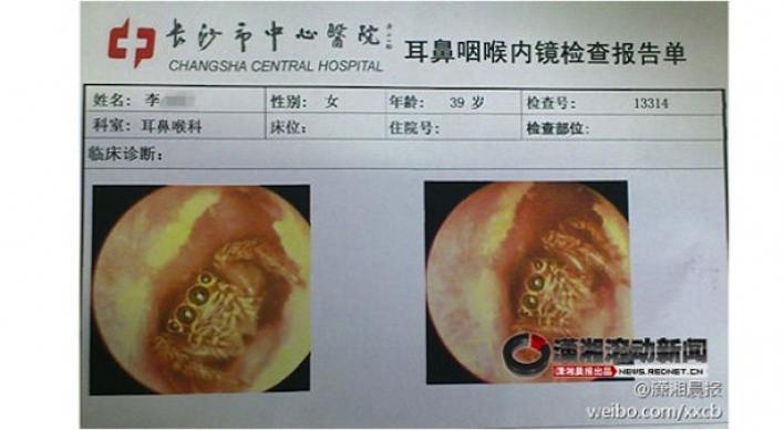Chinese doctors remove spider from patient’s ear canal