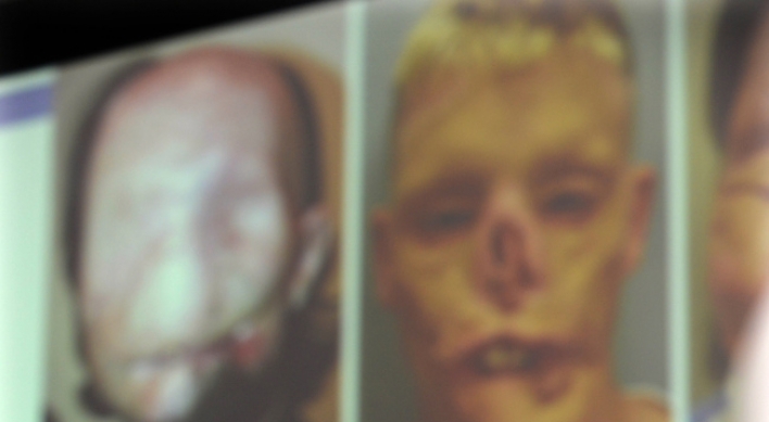 Face transplant patients thrive after operations