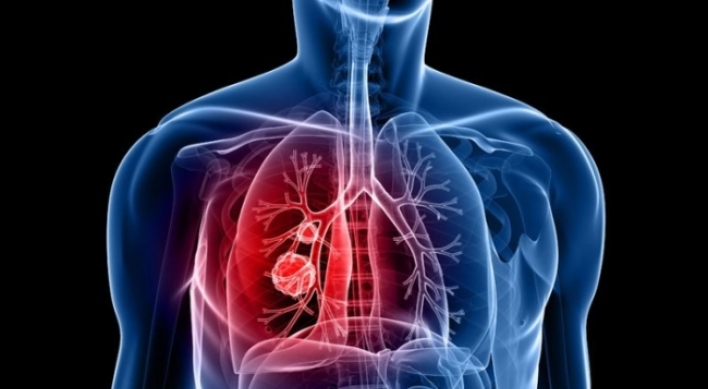 New microRNA may help diagnose lung cancer: study