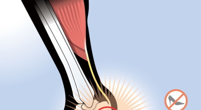 Plantar fasciitis