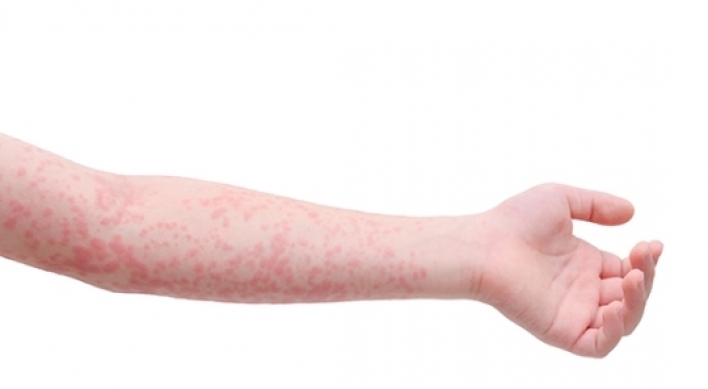 Scarlet fever increases hundredfold in 6 years