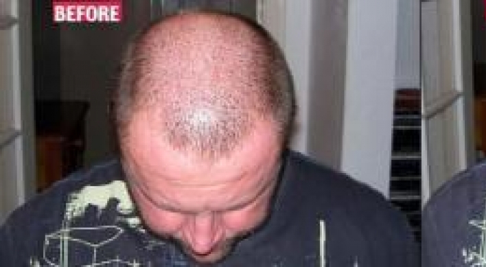 Solution to baldness, just $24