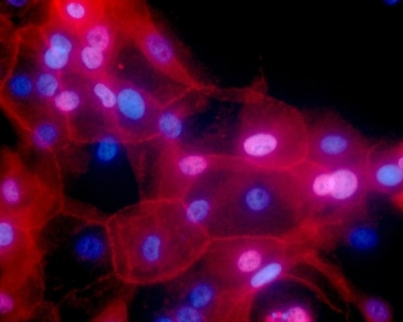 Immunotherapy scores a first win against some breast cancers
