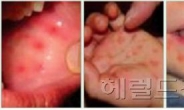 동아시아 수족구병 비상...중국ㆍ홍콩ㆍ싱가포르 2배, 베트남은 8.7배 발생 증가