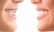 치아교정, 이제는 투명교정장치‘인비절라인’으로 심미성까지