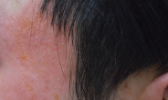 피부는 악건성인데 지루성피부염이라니?