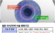 각막손상량 최소화 성공, 이제 라식/라섹 후 하루만에 일상복귀 가능