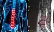 [건강 3650]장마철 유독 도지는 허리통증…혹시 디스크?