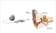 [건강 3650] 난청ㆍ이명, 중이임플란트로 해결한다