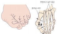 한국 중년 여성, 맨발의 마사이족보다 무지외반증 심해
