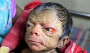80대 노인 얼굴로 태어난 천만분의 1 확률 ‘조로증 아기’