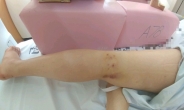 [단독]30대 여성 다리 부종시술 후 난치병…담당의사는 이직, 병원은 ‘나몰라라’?