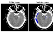 SK㈜ C&C ‘뇌출혈 영상 판독 AI모델’ 상용화 속도