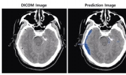SK㈜ C&C ‘뇌출혈 영상 판독 AI모델’ 상용화 속도