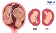 거꾸로 태어난 아이, 발달성 고관절 이형성증 검사해야