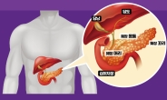 조기발견 시 높아지는 췌장암 생존율, 검사는 어떻게?