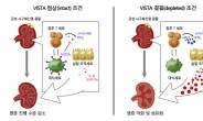 서울대병원, 급성 사구체신염 면역 매커니즘 최초 확인