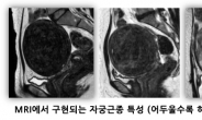 자궁근종 하이푸, 원칙 치료로 신경손상 및 재발 방지해야