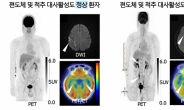 [김태열의 생생건강S펜] 뇌졸중 예후 악화, 뇌속 '편도체' 작용기전 입증