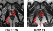 “5500만원짜리 꿈의 암 치료 받아 봤다” 6개월 뒤 놀라운 변화, 무슨 일이