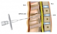 [김태열의 생생건강S펜] 자생한방병원, “한방 천연물로 척추관협착증 치료 효과 입증