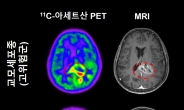 뇌 속 ‘별세포’, 뇌종양 최적 수술위치 찾아준다