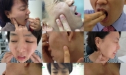 재발없는 ‘교근축소술’로 턱관절통증, 안면비대칭, 편두통까지 개선