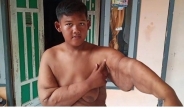 10살 몸무게가 192㎏?…印尼소년 위 축소 수술 후 87㎏ 변신