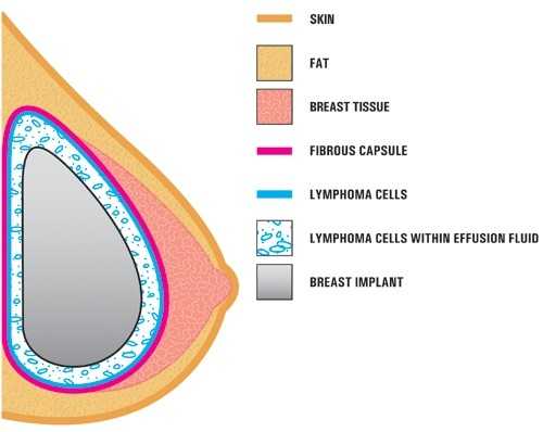 Are 'water drop' breast implants a ticking time bomb in the chest?